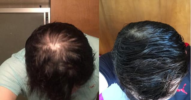 Ro member growing hair after treatment; before: top of head with large bald spot in the center; after: top of same head with thick hair