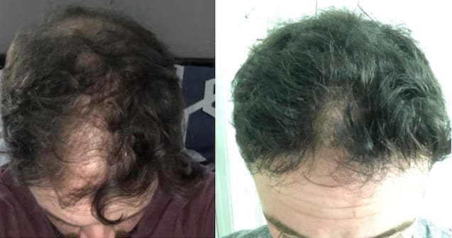 Ro member growing hair after treatment; before: receding hairline and bald areas on head; after: top of same head with thick hair