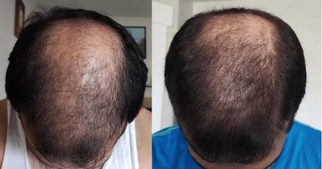 Ro member growing hair after treatment; before: top of head with large bald area; after: top of same head with more hair