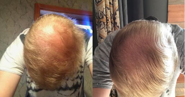 Ro member growing hair after treatment; before: top of head with large bald area; after: top of same head with more hair